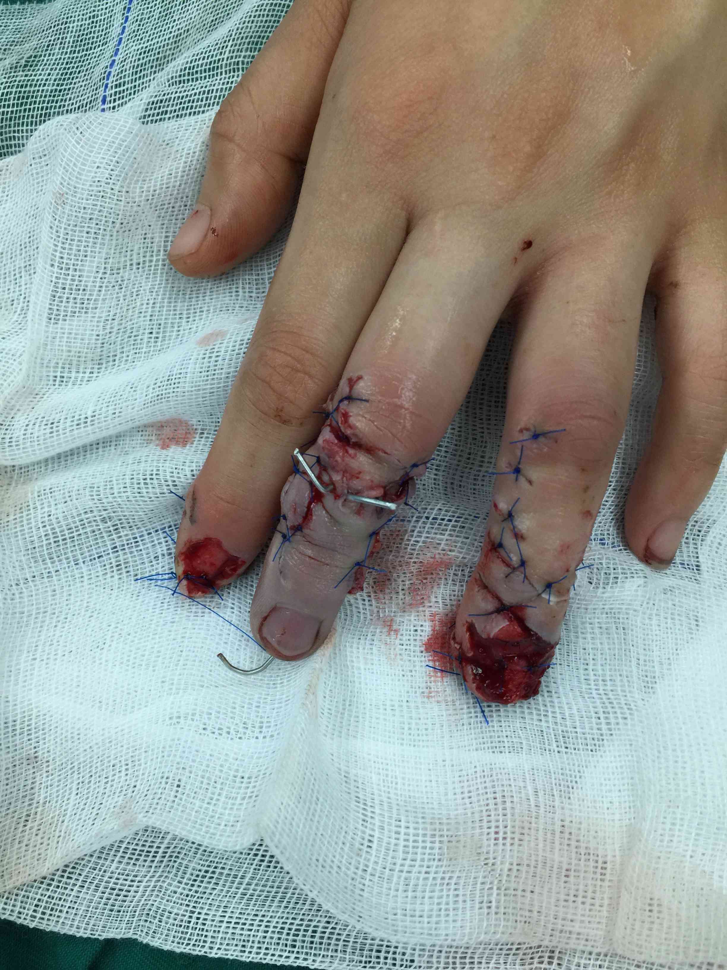 手指肌腱缝合术图片